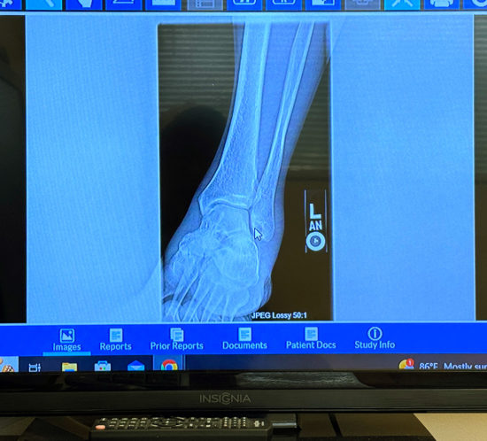 捻挫→剥離骨折→捻挫。