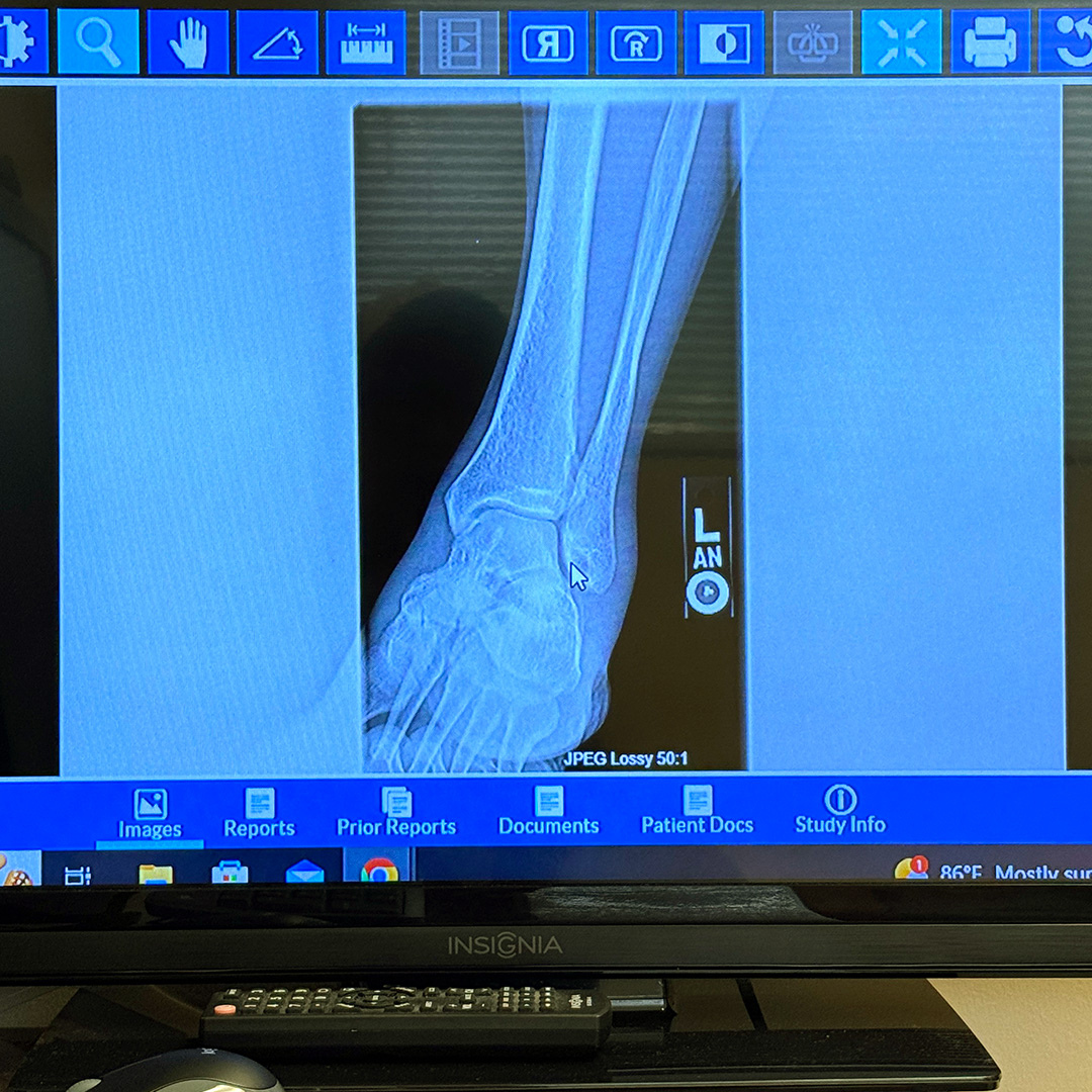 捻挫→剥離骨折→捻挫。